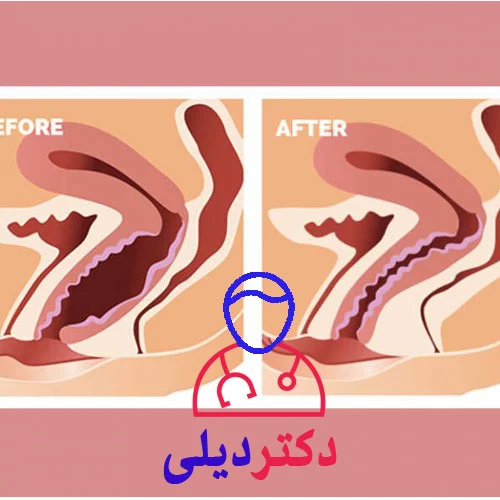 خرید قرص تنگ کننده واژن-دلایل اصلی گشادی واژن
