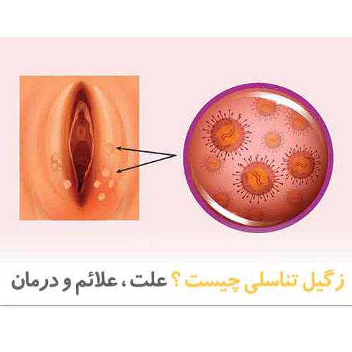 علائم زیگیل تناسلی